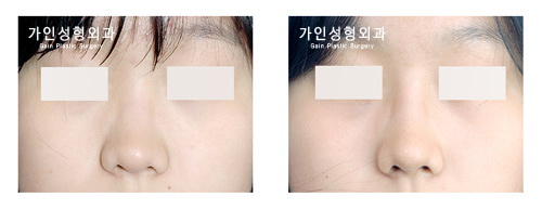 융비술