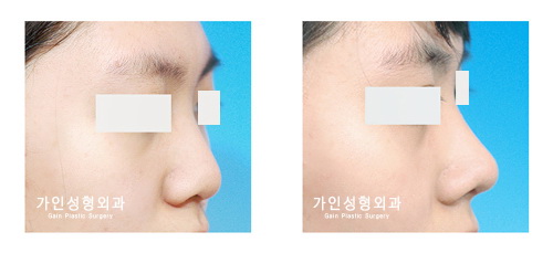 융비술