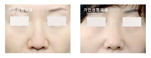 융비술
