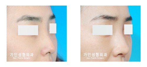 융비술