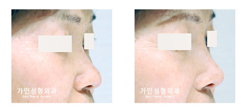 융비술