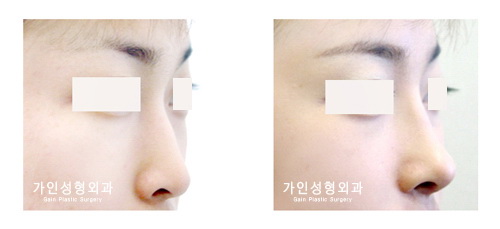 융비술