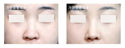 융비술