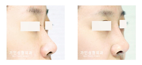 융비술