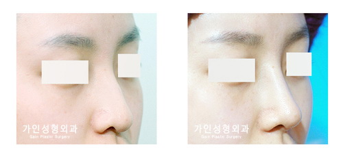 융비술