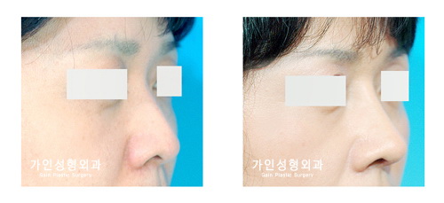 융비술