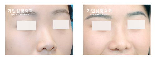 들창코
