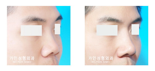 들창코