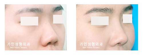 들창코