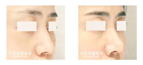 코끝성형