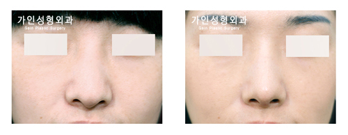코끝성형