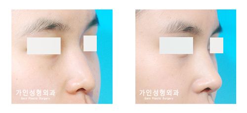 코끝성형