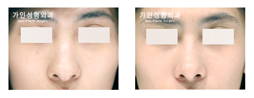 코끝성형