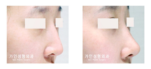 코끝성형