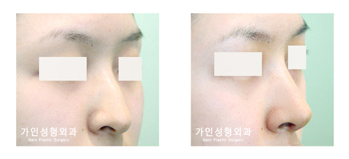 코끝성형