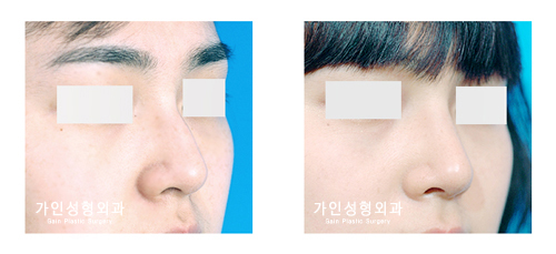 코끝성형