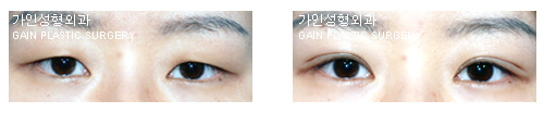촉촉한눈매가 이쁜  매몰법~  3주 !