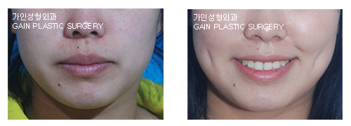보조개수술