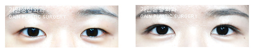 부분절개법
