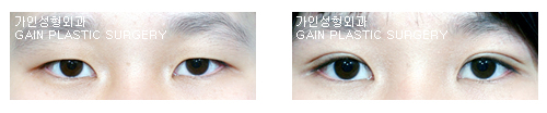 매몰법