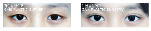 매몰법