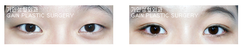 매몰법
