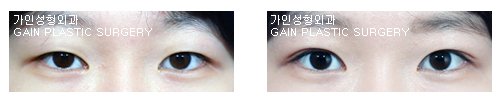 매몰법
