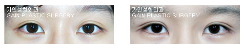 매몰법