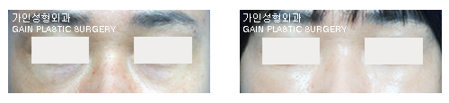 하안검[눈밑지방재배치]