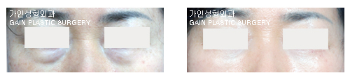 하안검[눈밑지방재배치] 
