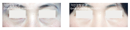 하안검[눈밑지방재배치]