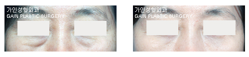 하안검[눈밑지방재배치] 