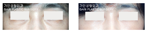 하안검[눈밑지방재배치] 