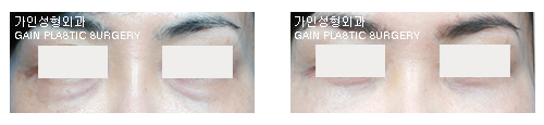 하안검[눈밑지방재배치] 
