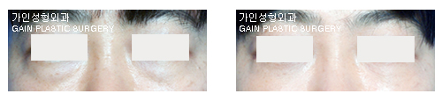 하안검[눈밑지방재배치] 
