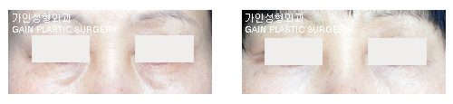 하안검[눈밑지방재배치]