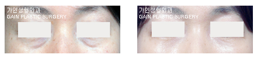 하안검[눈밑지방재배치]