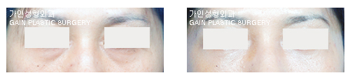 하안검[눈밑지방재배치] 