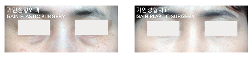 하안검[눈밑지방재배치]
