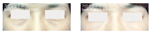 하안검[눈밑지방재배치]