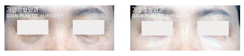 하안검[눈밑지방재배치] 