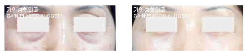 하안검[눈밑지방재배치]