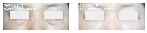 하안검[눈밑지방재배치] 