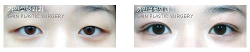 매몰법