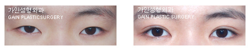 절개법/ 무흉앞트임