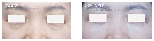 하안검[눈밑지방재배치]