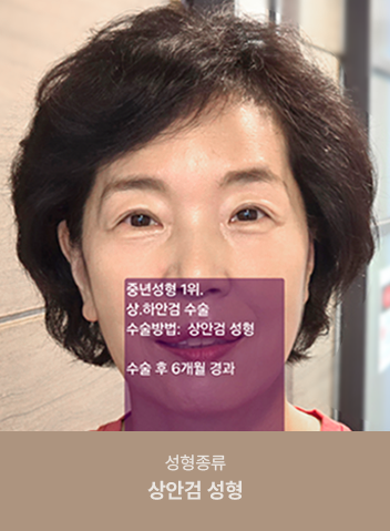 리얼스토리-쌍꺼풀_수술