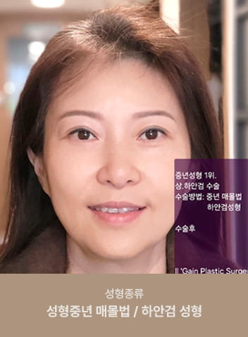 리얼스토리-꺼진_눈 지방이식