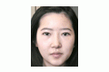 앞턱+이마 , 매부리코, 절개법, 앞트임