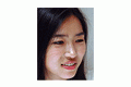 절개법/앞트임/코성형/무턱